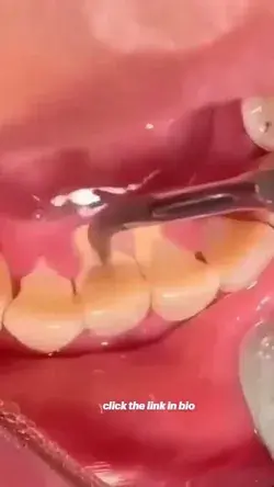 tartar removal with bleeding gums