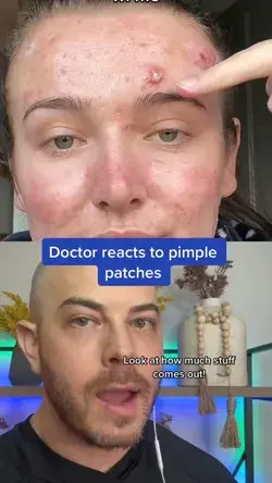 Derm reacts to pimple patch removal! #pimplepopper
