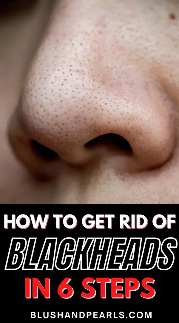 How To Get Rid Of Blackheads in 6 Steps