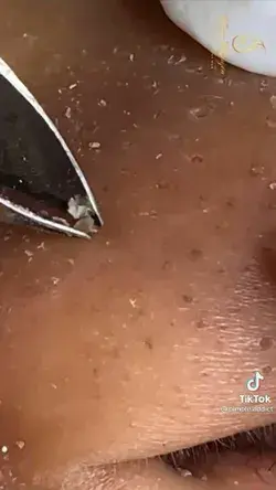 blackhead removal