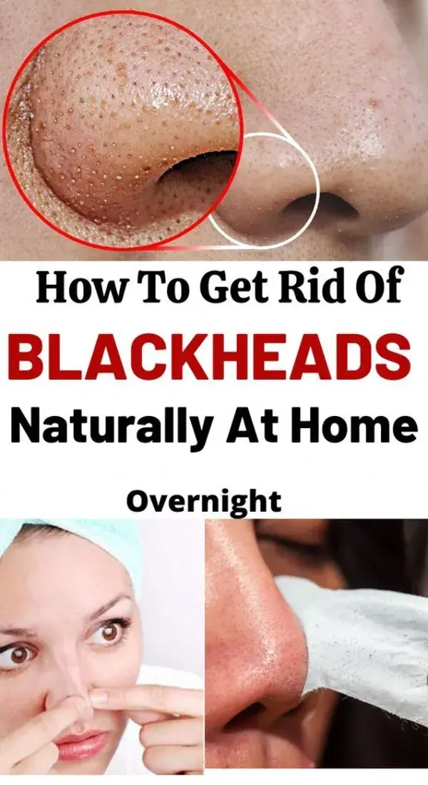 Blackheads Removal That Gives You Perfect Skin