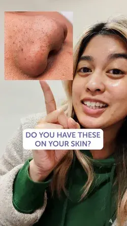 Do you Have Blackheads on your Nose?