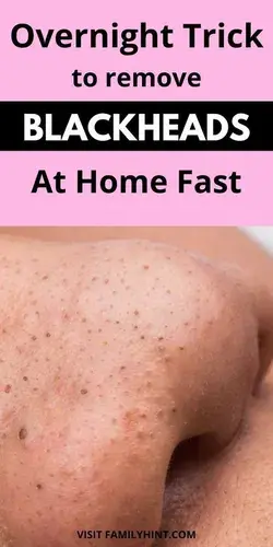 Overnight Trick To Remove Blackheads Blackheads At Home Fast