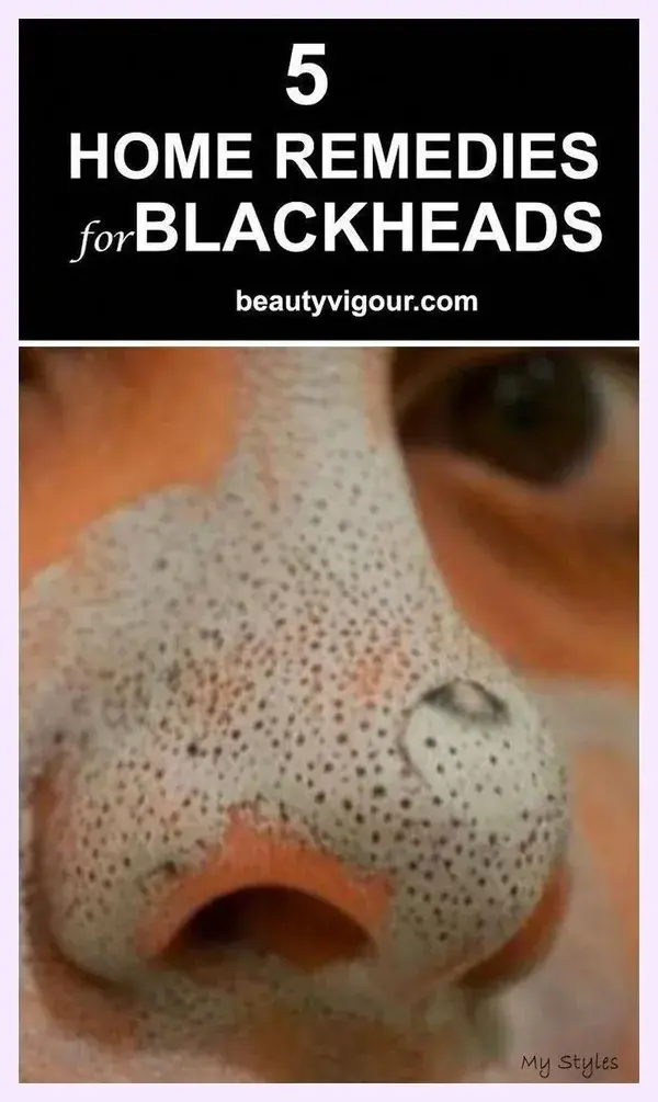 Say Goodbye to Blackheads on Your Face With Only 2 Ingredients