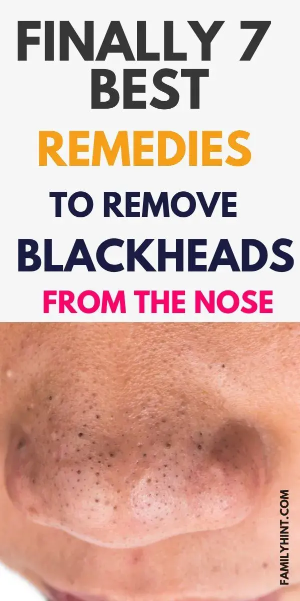 How To Get Rid of Blackheads Naturally (7 Proven Home Remedies)