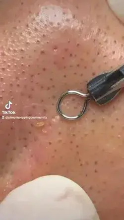 Blackhead removal