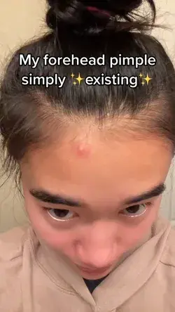 My forehead pimple