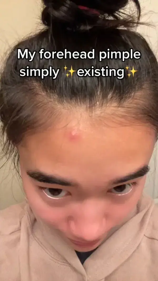 My forehead pimple