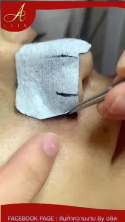 Blackhead removal link in bio ❤️