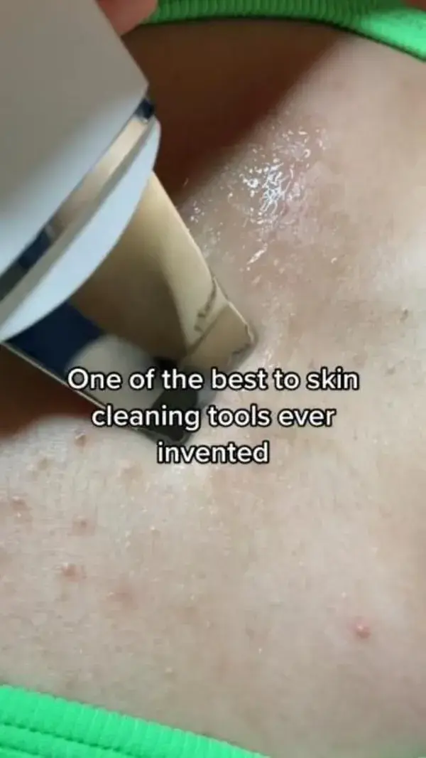 Remove Blackheads and other dirt in your skin with ease