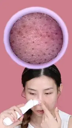 Blackhead Remover