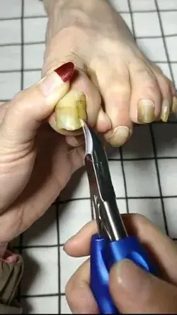 Medical-Grade Toenail Clippers