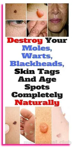HOW TO REMOVE MOLES, WARTS, BLACKHEADS, SKIN TAGS, AND AGE SPOTS COMPLETELY NATURALLY