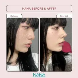 Natural nose upgrade with NANA, never too exaggerated 🥰