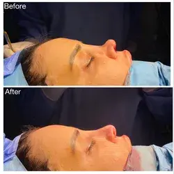 Revision rhinoplasty using auricular cartridge graft