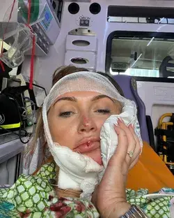 Charlotte Dawson hospitalised with facial injuries after scooter crash in Rome: ‘I’ve been very lucky’