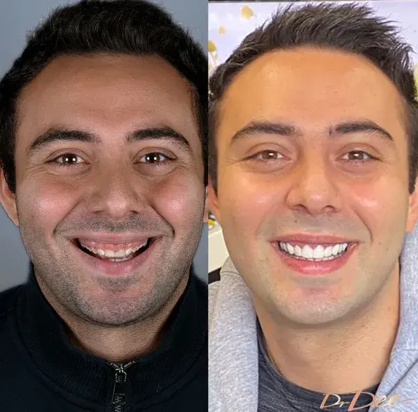 Laser Gum Lift + Porcelain Veneers by Dr. Dee