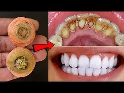 how to whiten teeth with baking soda, carrots in two minutes at home.