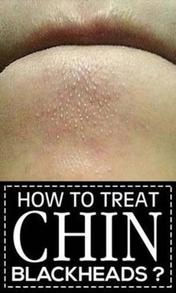 How To Treat Chin Blackheads?