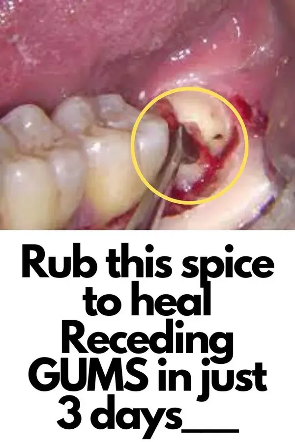 Rub this spice to heal Receding GUMS in just 3 days___🔥