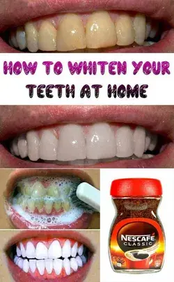 Teeth whitening and scaling in 1 minute, you will have pearl white teeth