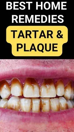 8 Natural Ways to Remove Tartar from Your Teeth