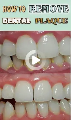 How To Remove Tartar Buildup | Tooth Decay