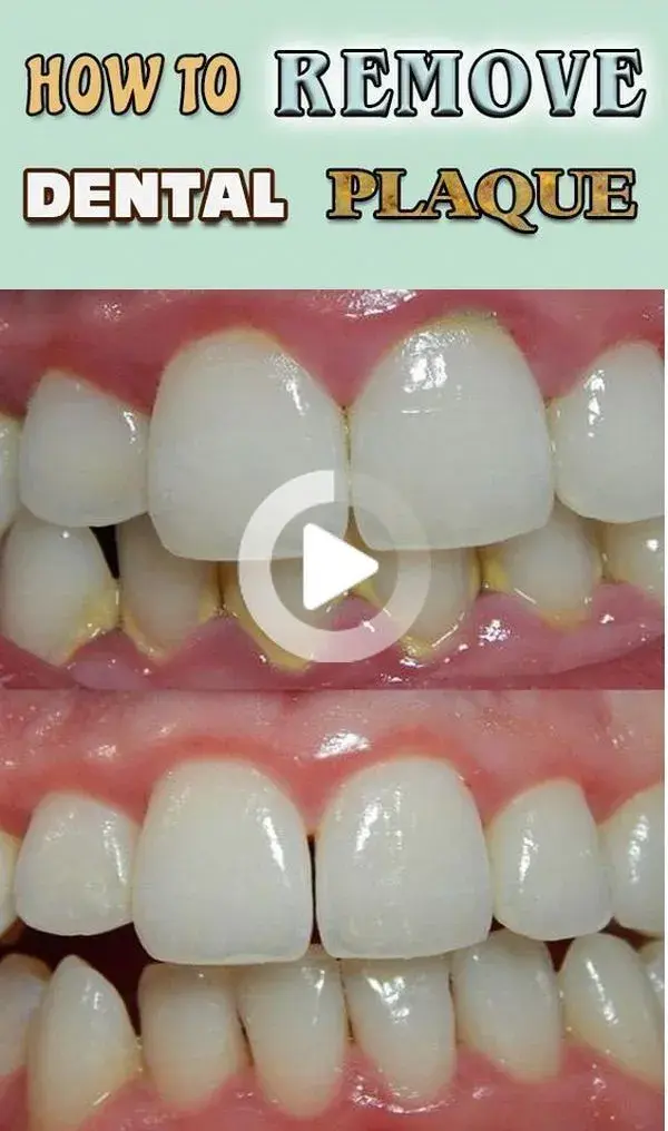 How To Remove Tartar Buildup | Tooth Decay