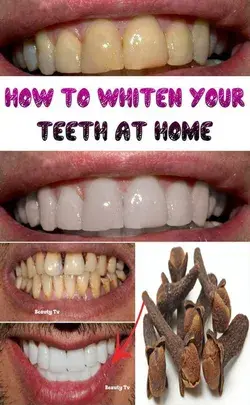 Teeth whitening and scaling in 1 minute, you will have pearl white teeth