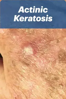 Actinic Keratosis