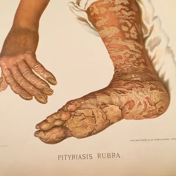 Pityriasia Rubra - Antique Skin Disease Print, Large 1889 Color Lithograph, Taylor's Atlas of Skin Diseases