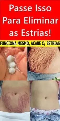 Eliminar Estrias