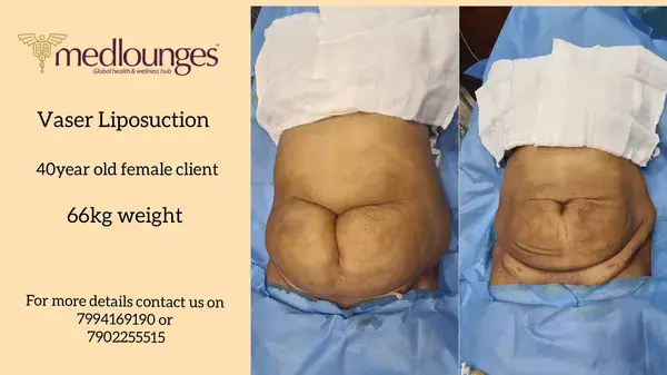 Breast Augmentation with Fat Transfer (Vaser Liposuction) with @Medlounges Wellness