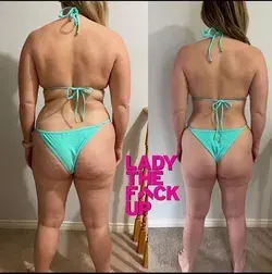 She Removed Excess fat around her belly and hips!!