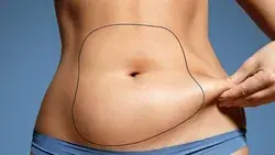 Risks of Liposuction