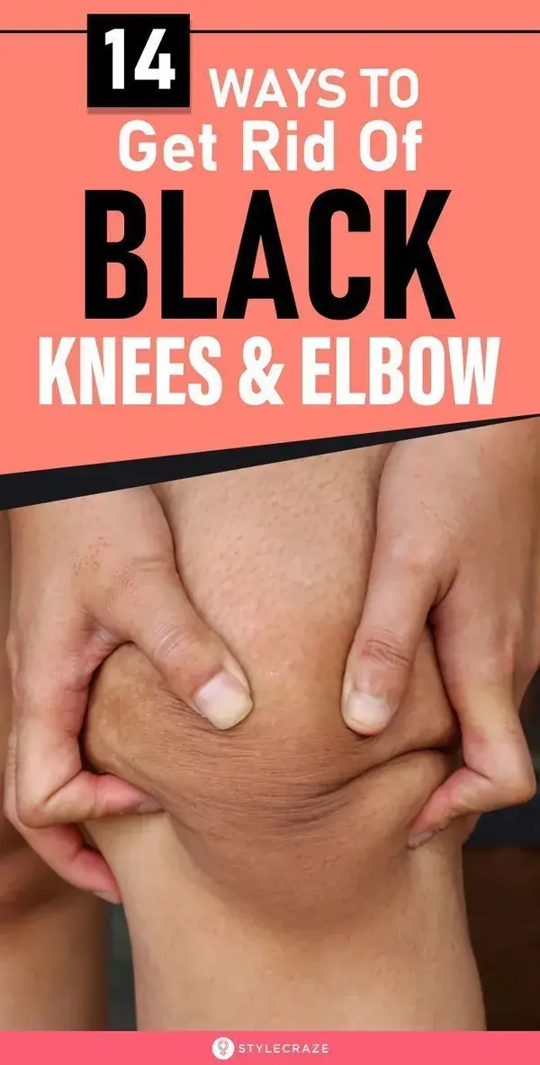 14 Ways To Get Rid Of Black Knees And Elbow