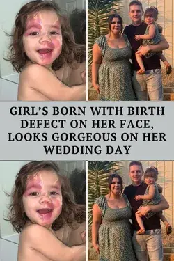 Girl’s Born With Birth Defect On Her Face, Looks Gorgeous On Her Wedding Day