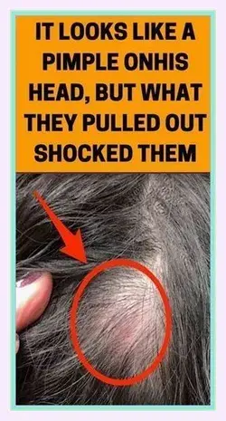 It Looks Like A Pimple On His Head, But What They Pulled Out Shocked Them