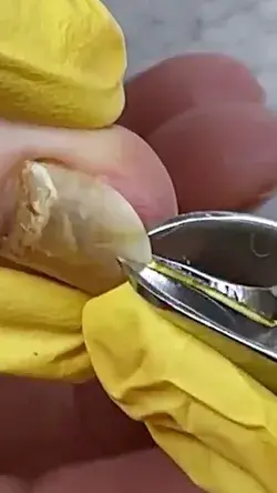 Treating an injured nail🤕