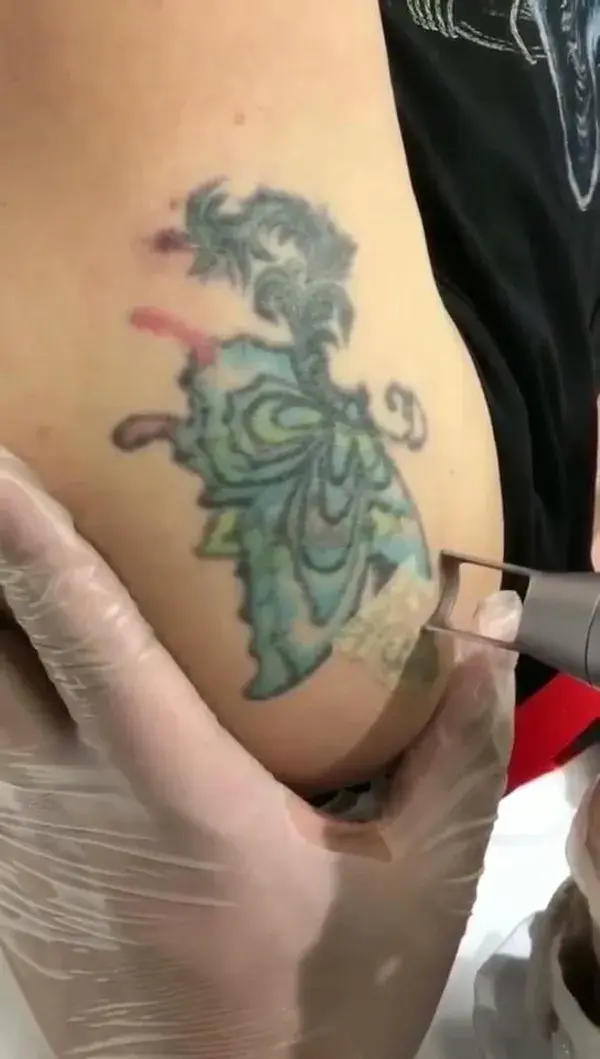 Pico laser tattoo removal