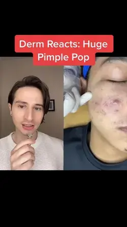 Derm Reacts: Huge Pimple Pop