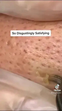 Blackheads popping