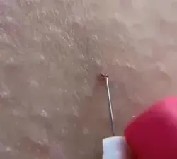 Ingrown hair