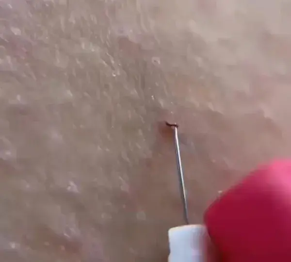 Ingrown hair