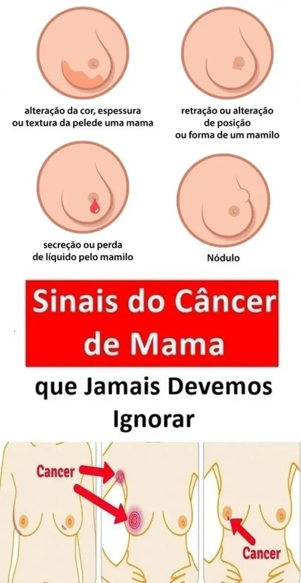 (CONFIRA AQUI) Sinais do câncer de mama que jamais devemos ignorar!!