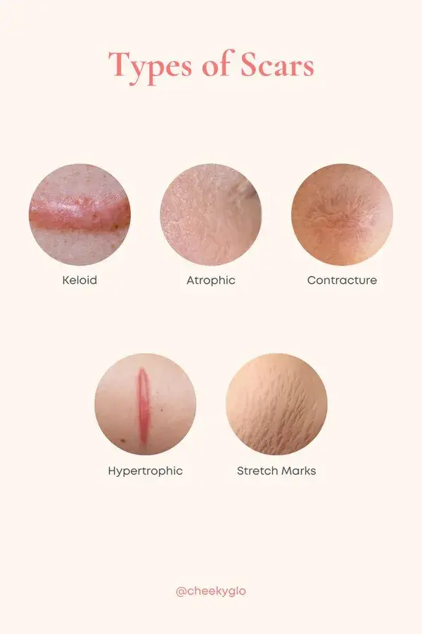 Types of Scars