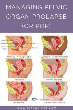 Managing pélvic prolapse