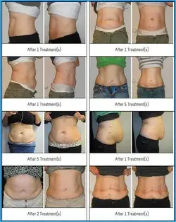 Here are ways to remove muffin top | Girls who are lazier to