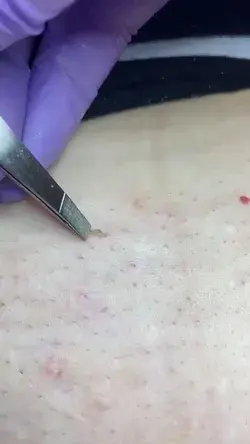 Blackheads Oddly satsfying