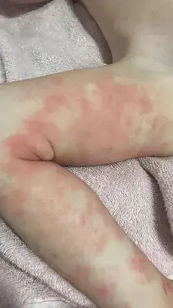 BEFORE & AFTER BABY ECZEMA RESULTS!